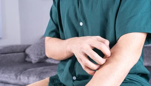 Małpia ospa budzi niepokój i rodzi wiele pytań. Postanowiliśmy odpowiedzieć na te najczęstsze