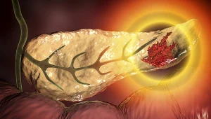 Rak trzustki wykrywany jest zazwyczaj w zaawansowanym stadium