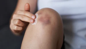 Osoby ze skłonnością do siniaków powinny zawsze mieć maść arnikową w domowej apteczce