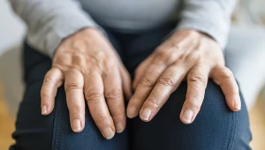 Objawy dny moczanowej pojawiają się najpierw na stawach dłoni i stóp