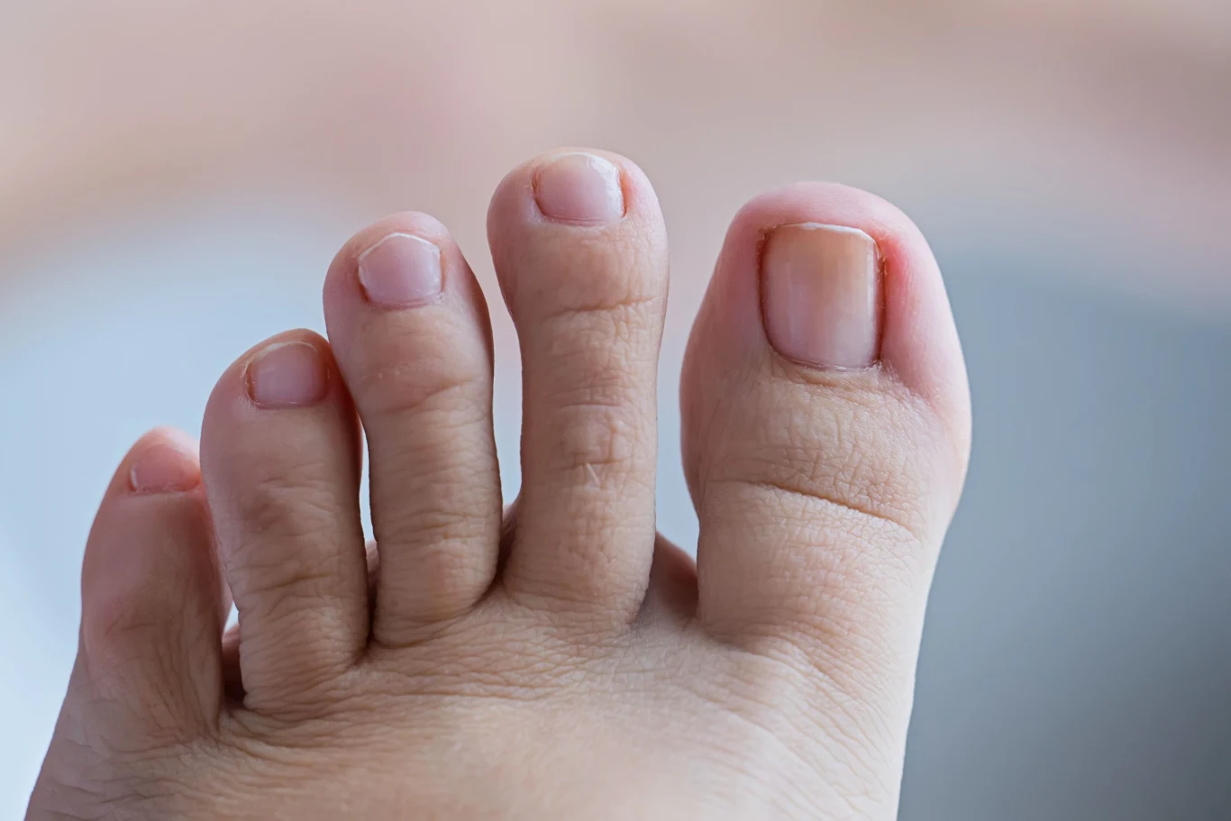 Stopę grecką posiada około 20 proc. populacji. Jej posiadacze często narzekają na odciski na drugim palcu