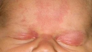 Nazywane są uszczypnięciem bociana. Rodzice martwią się o powikłania