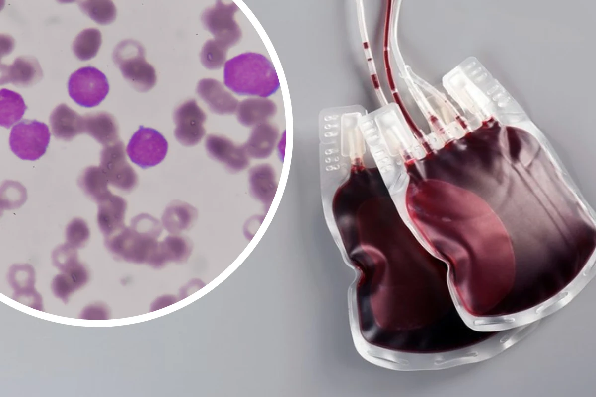 Oprócz białaczek i chłoniaków , hematolodzy leczą także inne nowotwory krwi, m.in. czerwienicę prawdziwą, włóknienie szpiku czy szpiczaka mnogiego. Oprócz białaczek i chłoniaków , hematolodzy leczą także inne nowotwory krwi, m.in. czerwienicę prawdziwą, włóknienie szpiku czy szpiczaka mnogiego.