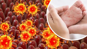 W Polsce odnotowano wzrost zachorowań na odrę, świnkę i różyczkę. Wyjaśniamy, jak objawiają się te choroby