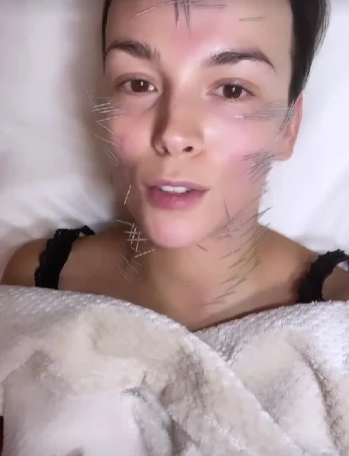 Paulina Krupińska pokazała w sieci inwazyjny zabieg twarzy. Paulina Krupińska pokazała w sieci inwazyjny zabieg twarzy.