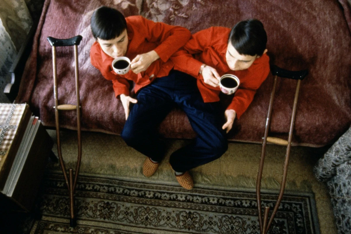 Rozdzielenie operacyjne nie zawsze jest możliwe, wszystko zależy od tego, jakie narządy wewnętrzne dzieli z sobą rodzeństwo