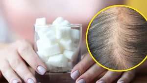 Nadmiar cukru w diecie może prowadzić do nagłej utraty włosów, w tym powoduje również łysienie androgenowe
