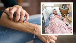 Swędzenie skóry to często bagatelizowany objaw. U 30-latki był sygnałem rozwijającego się nowotworu
