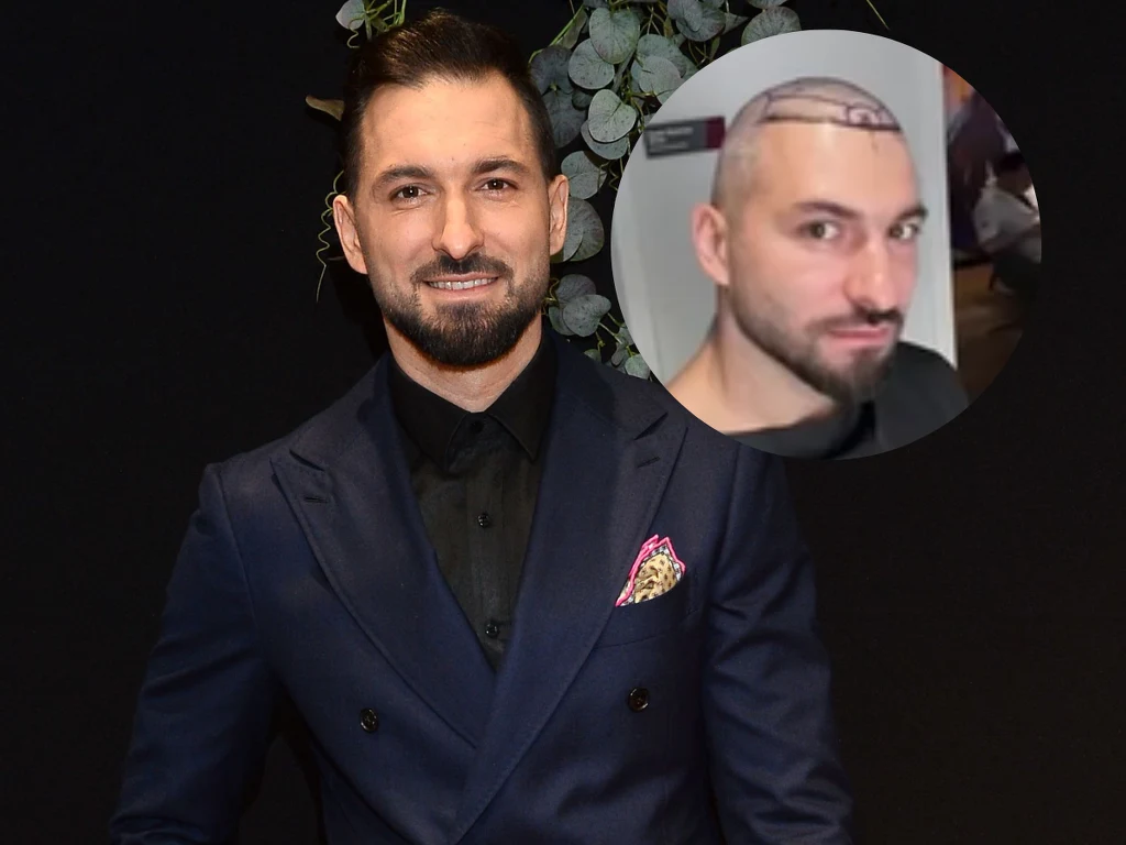 Rafał Maślak miał przeszczep włosów Rafał Maślak miał przeszczep włosów