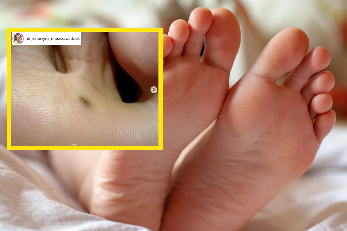 Czerniak to też taka niewinna plamka - udowadnia dr Muras-Szwedziak