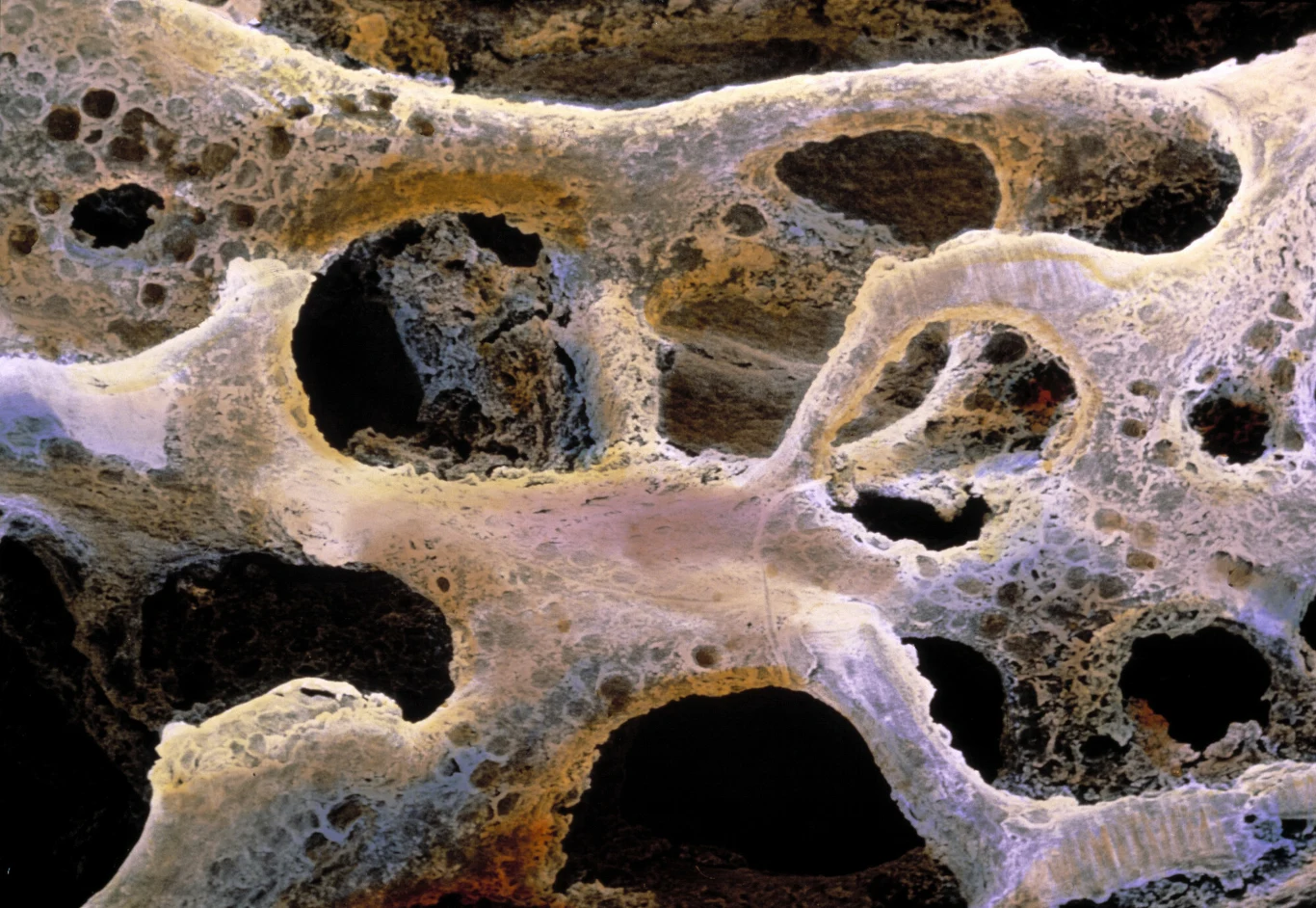 "Cicha złodziejka kości" może przez lata siać spustoszenie w naszym ciele