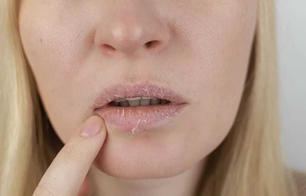 W czasie mrozów usta mogą pękać i piec
