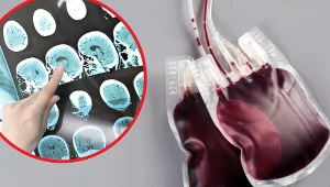 Osoby z grupą krwi A są w grupie ryzyka. Udar występuje u nich częściej