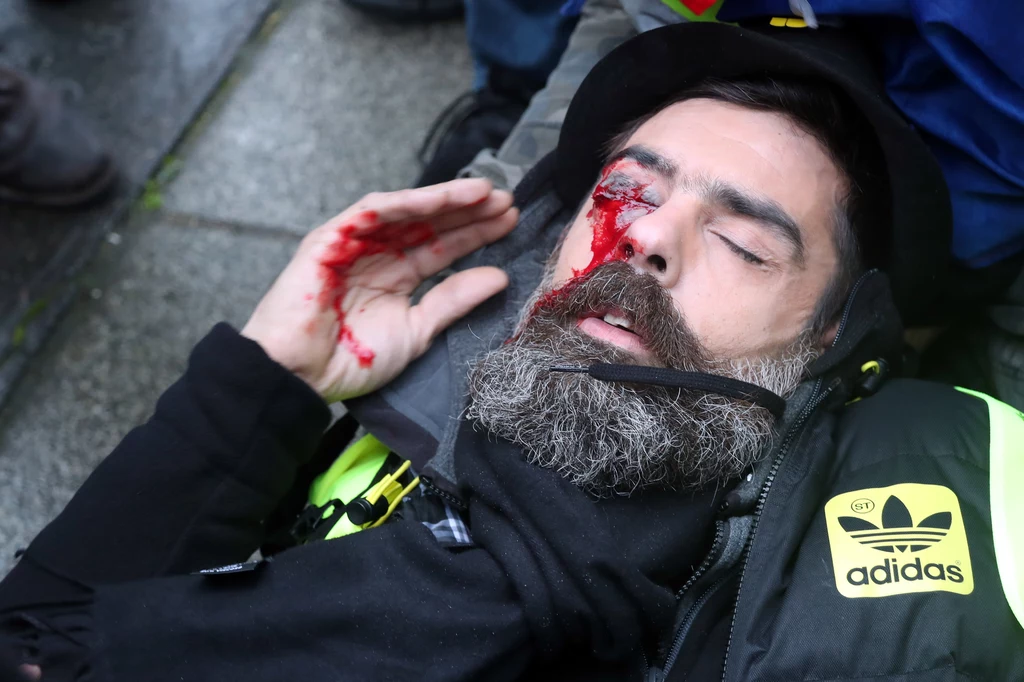 Jerome Rodrigues, jeden z liderów "żółtych kamizelek", tuż po postrzeleniu przez policję w trakcie demonstracji w Paryżu w styczniu 2019 r. Jerome Rodrigues, jeden z liderów "żółtych kamizelek", tuż po postrzeleniu przez policję w trakcie demonstracji w Paryżu w styczniu 2019 r.