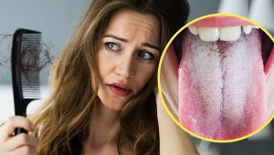 "Nie mam na nic siły i tracę włosy". Kobieta opisuje objawy po grypie