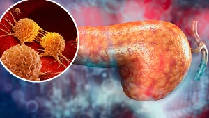 Ustalono, co karmi raka trzustki. Kobiety muszą uważać szczególnie