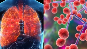 Kandydoza, jeśli dotrze do płuc, początkowo udaje grypę lub infekcję. Wywołują duszności i kaszel