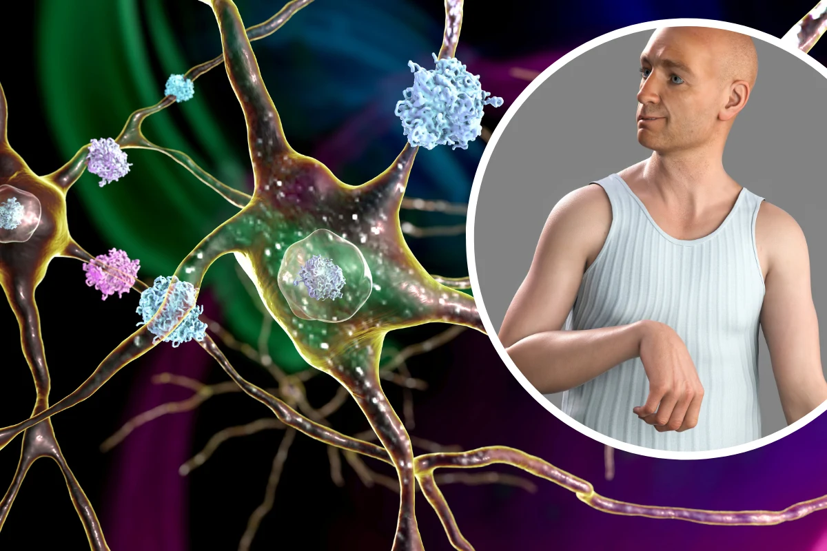 Choroba ma podłoże genetyczne. Pląsawica Huntingtona to nieodwracalne zmiany neurodegeneracyjne Choroba ma podłoże genetyczne. Pląsawica Huntingtona to nieodwracalne zmiany neurodegeneracyjne