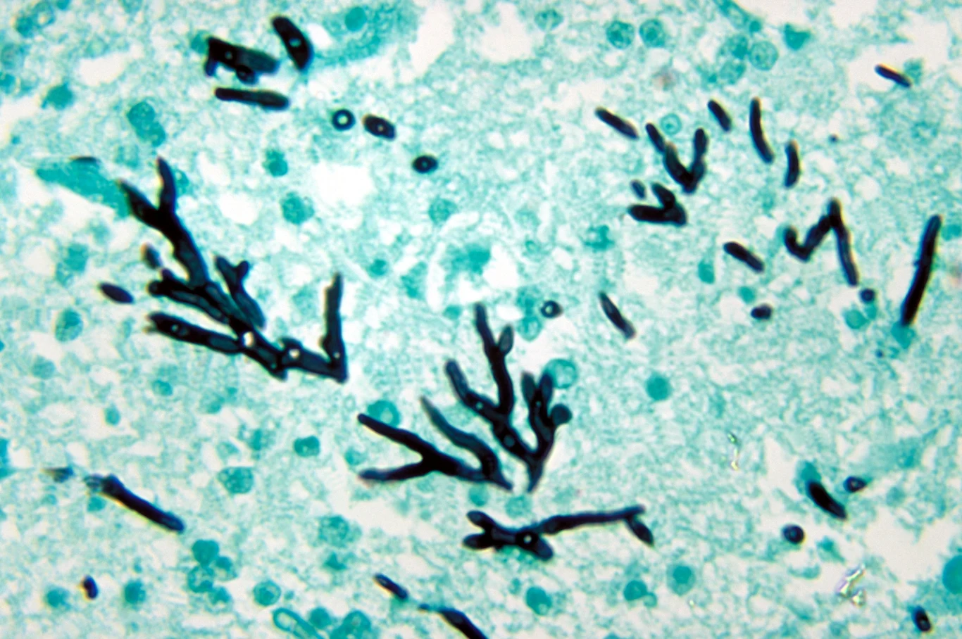 Aspergillus fumigatus to grzyb wewnątrzdomowy, który powoduje powoduje ostre alergie, infekcje dróg oddechowych, niewydolność płuc, grzybicę uszu, oczu i zatok. Może prowadzić do zgonu pacjenta