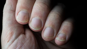 Łuszczycowe zmiany paznokciowe występują u ok. połowy pacjentów z łuszczycą zwyczajną, a częściej, bo w ponad 80 proc. przypadków, u osób z łuszczycą stawową