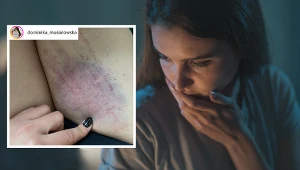 Nieoczywiste objawy nietolerancji glutenu. "Ciało odmawia posłuszeństwa"