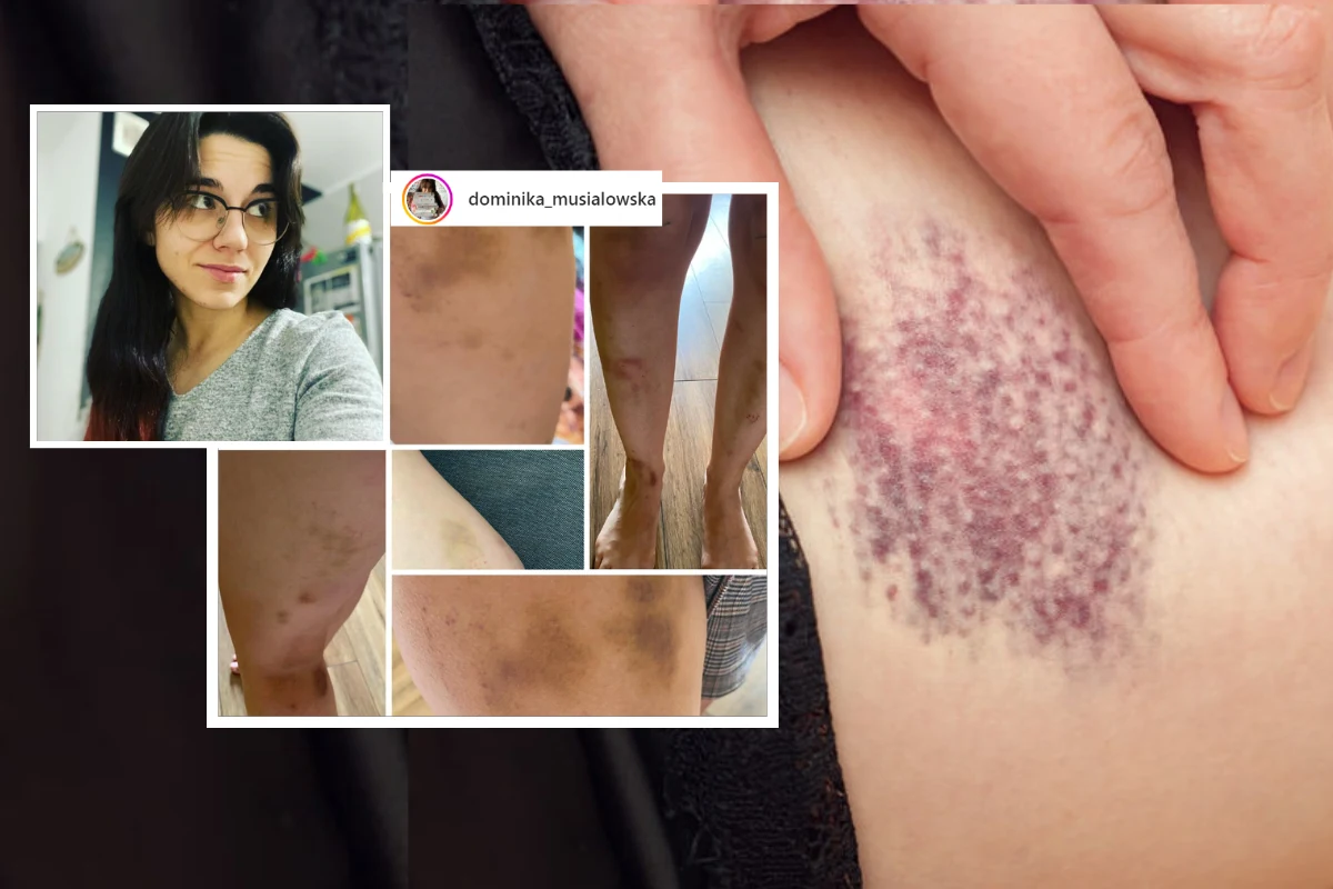 Dominika Musiałowska od lat edukuje ludzi w temacie insulinooporności i celiakii. Zdjęcia jej posiniaczonych nóg obiegły całą Polskę /instagram.com/dominika_musialowska