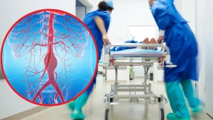 Choroba tkanki łącznej może spowodować zniekształcenie się tętnic i powstanie tętniaka aorty