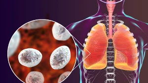 Pneumocystoza rozwija się niemal wyłącznie u osób z osłabionym układem odpornościowym. Najliczniejszą grupą pacjentów są chorzy z zakażeniem HIV