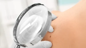 Przełom w badaniach nad rakiem skóry. Odkryto kluczowy mechanizm ochrony