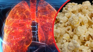 Popcornowe płuca swoją nazwę biorą z faktu, że w badaniu RTG oskrzeliki kształtem przypominają prażoną kukurydzę