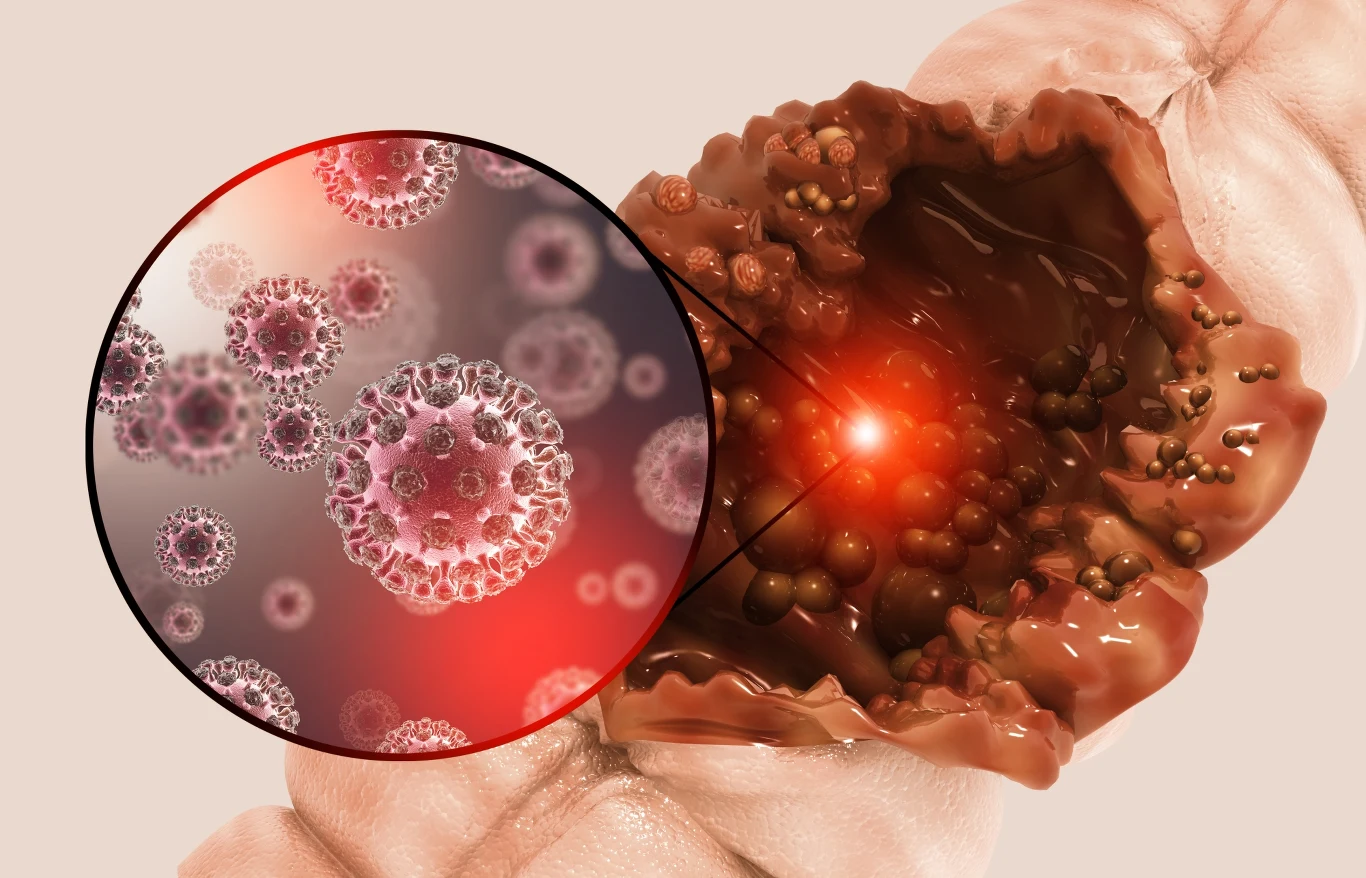 Rak jelita grubego nie dotyczy wyłącznie osób starszych. Coraz częściej atakuje osoby młode