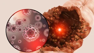 Rak jelita grubego może występować rodzinnie. Wyjaśniamy, jakie badania wykonać, kiedy u członka rodziny wykryto tę chorobę