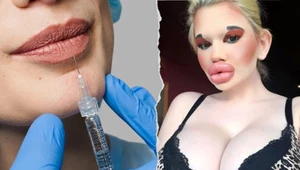 25-latka jest fanką operacji plastycznych. Jej usta są największe na świecie  
