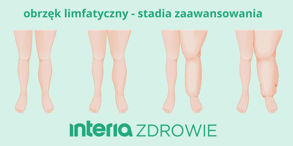 Obrzęk limfatyczny narasta, stopniowo odbierając zdrowie i sprawność Obrzęk limfatyczny narasta, stopniowo odbierając zdrowie i sprawność