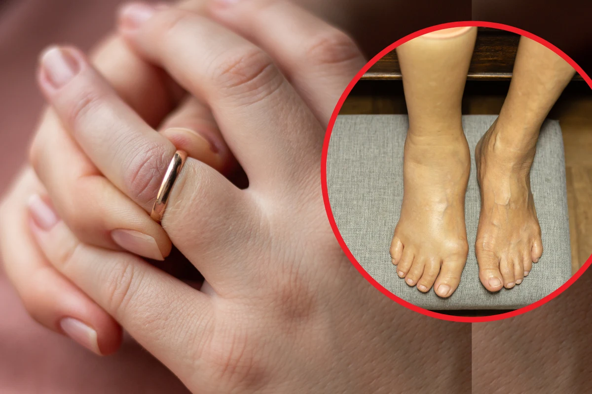 Początkowo obrzęk limfatyczny objawia się powiększeniem i obrzękiem kończyn Początkowo obrzęk limfatyczny objawia się powiększeniem i obrzękiem kończyn