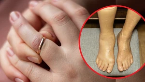 Początkowo obrzęk limfatyczny objawia się powiększeniem i obrzękiem kończyn