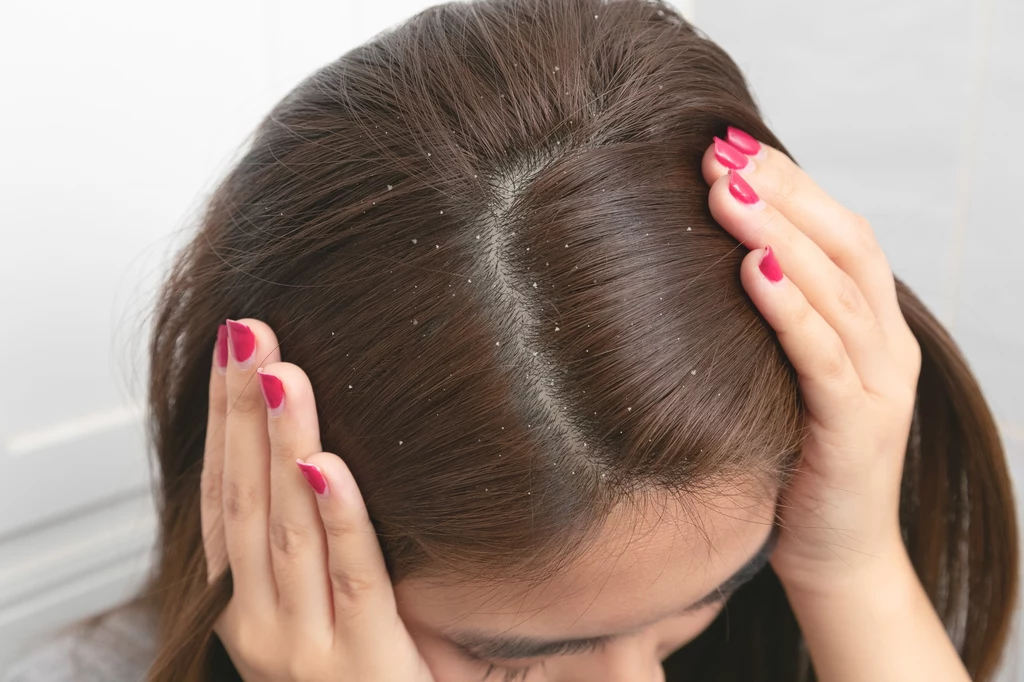 Żel aloesowy jest pomocny w walce z łupieżem i wypadaniem włosów