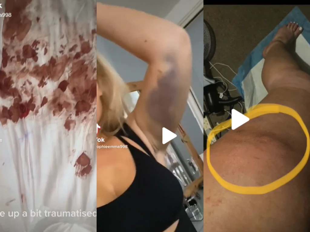 Zrobiła lifting pośladków i prawie umarła. Pokazała drastyczne zdjęcia