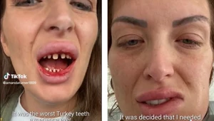 Wzięła kredyt na piękne zęby. Poleciała do Turcji i przeżyła horror