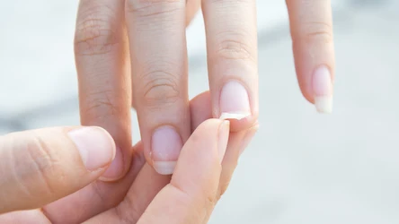 Masz łamliwe paznokcie? Sięgnij po naturalne rozwiązanie w postaci olejku z drzewa herbacianego. 