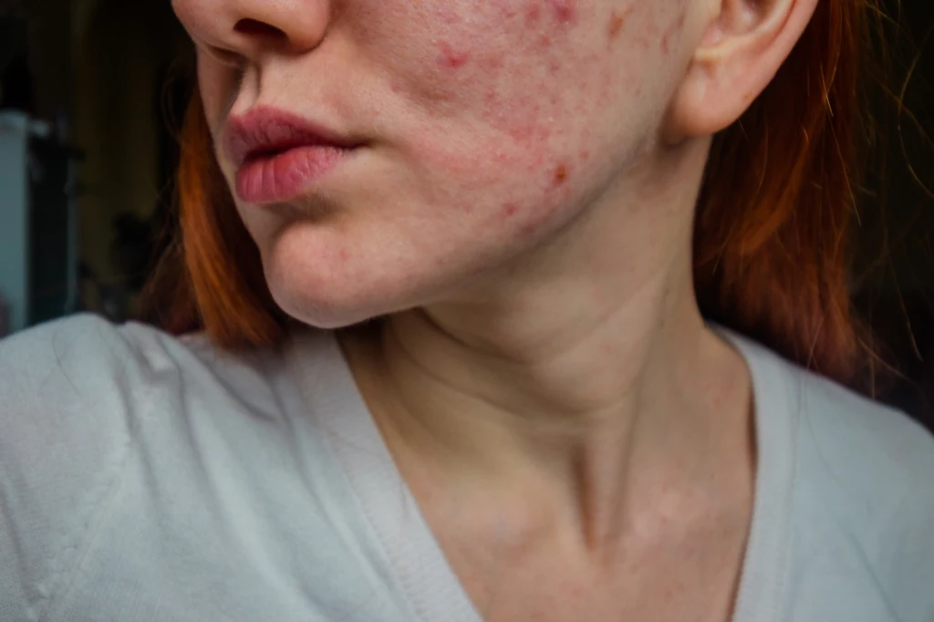 W walce z trądzikiem popełniamy często podstawowe błędy. Jakie? Jak prawidłowo dbać o skórę trądzikową? Wyjaśniamy 