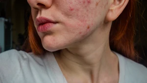 W walce z trądzikiem popełniamy często podstawowe błędy. Jakie? Jak prawidłowo dbać o skórę trądzikową? Wyjaśniamy 