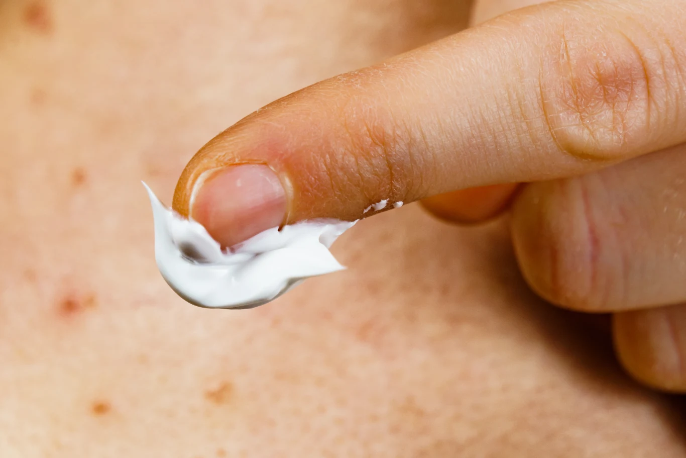 Skórę trądzikową trzeba traktować delikatnie