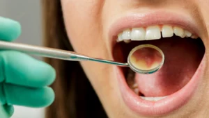 Co można zrobić z zębami na NFZ? O tych zabiegach nie miałeś pojęcia