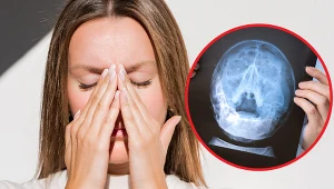 Czym objawiają się torbiele w zatokach? Kaszel i brak węchu bywają mylące