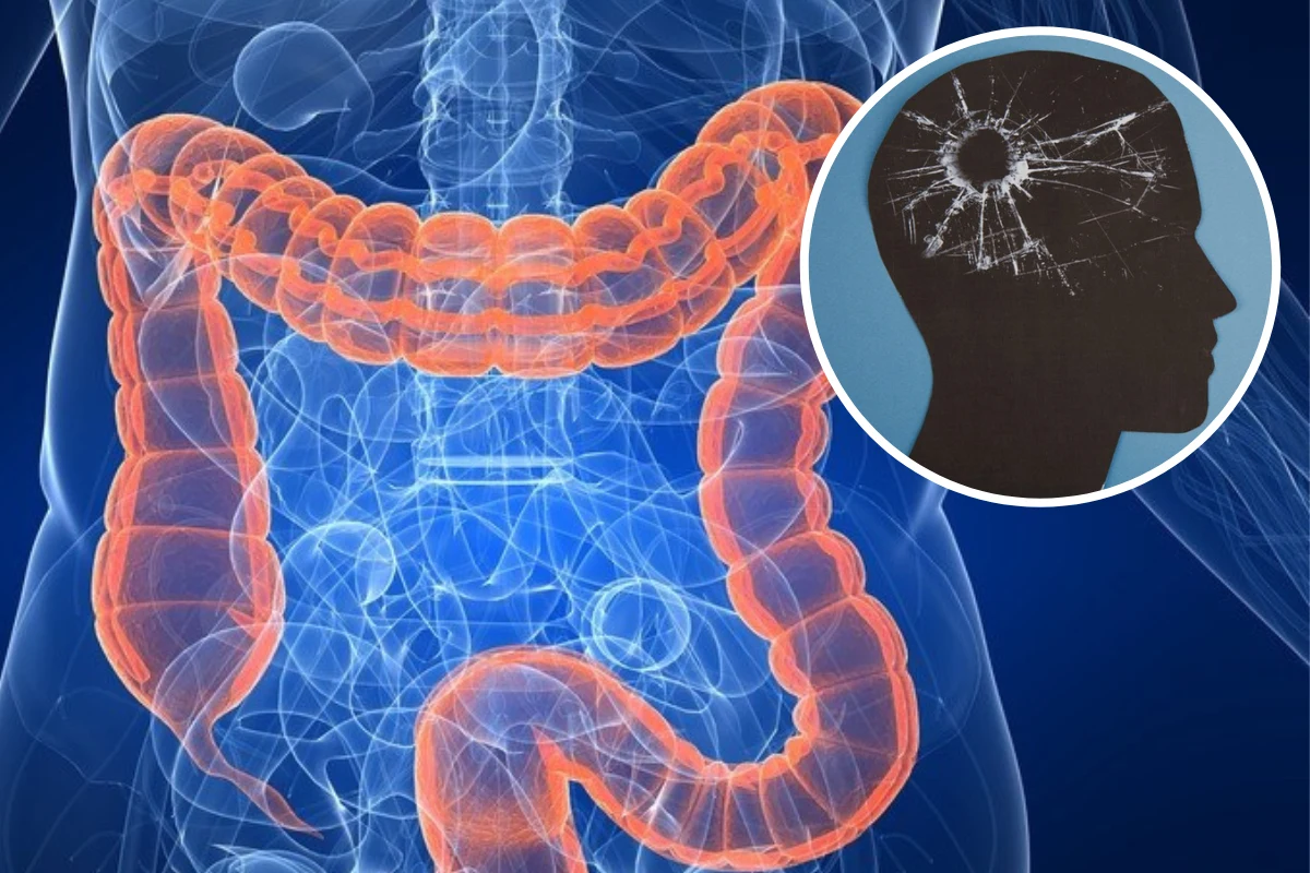 Naukowcy odkryli, że pewien szczep bakterii w jelitach wzmaga demencję i utratę pamięci u myszy oraz prawdopodobnie u ludzi Naukowcy odkryli, że pewien szczep bakterii w jelitach wzmaga demencję i utratę pamięci u myszy oraz prawdopodobnie u ludzi