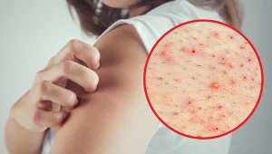 Nie rozdrapuj ani nie wyciskaj, tylko idź do lekarza. Takie ramiona to może być objaw choroby lub nietolerancji pokarmowej