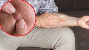 Domowe sposoby na bolesnego guza. Przyczyną może być brak higieny