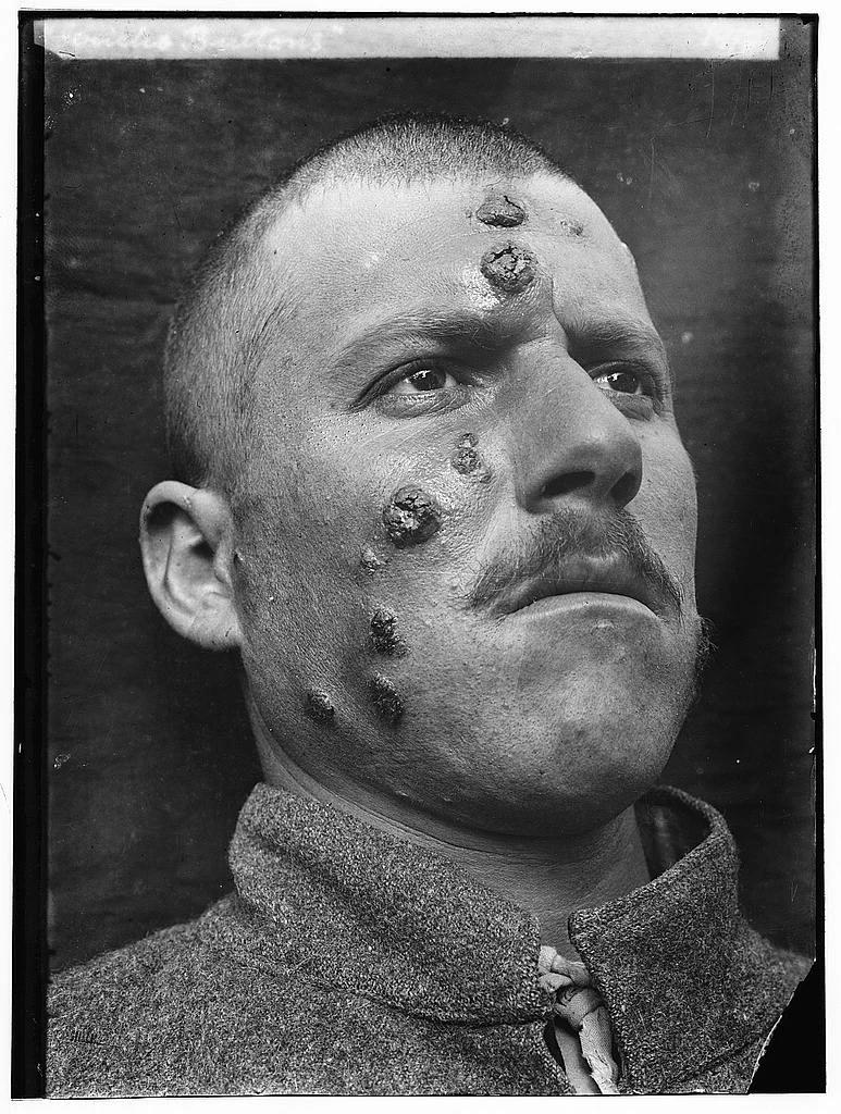 Przypadek leiszmaniozy skórnej z 1917 z Palestyny. W tamtym czasie chorobę nazywano też "pryszcze Jerycha" - po epidemii, która wybuchła w okolicach tego miasta Przypadek leiszmaniozy skórnej z 1917 z Palestyny. W tamtym czasie chorobę nazywano też "pryszcze Jerycha" - po epidemii, która wybuchła w okolicach tego miasta