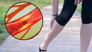 Bolesne skurcze mogą być spowodowane zmianami w obrębie naczyń tętniczych, które utrudniają prawidłowy przepływ krwi do mięśnia